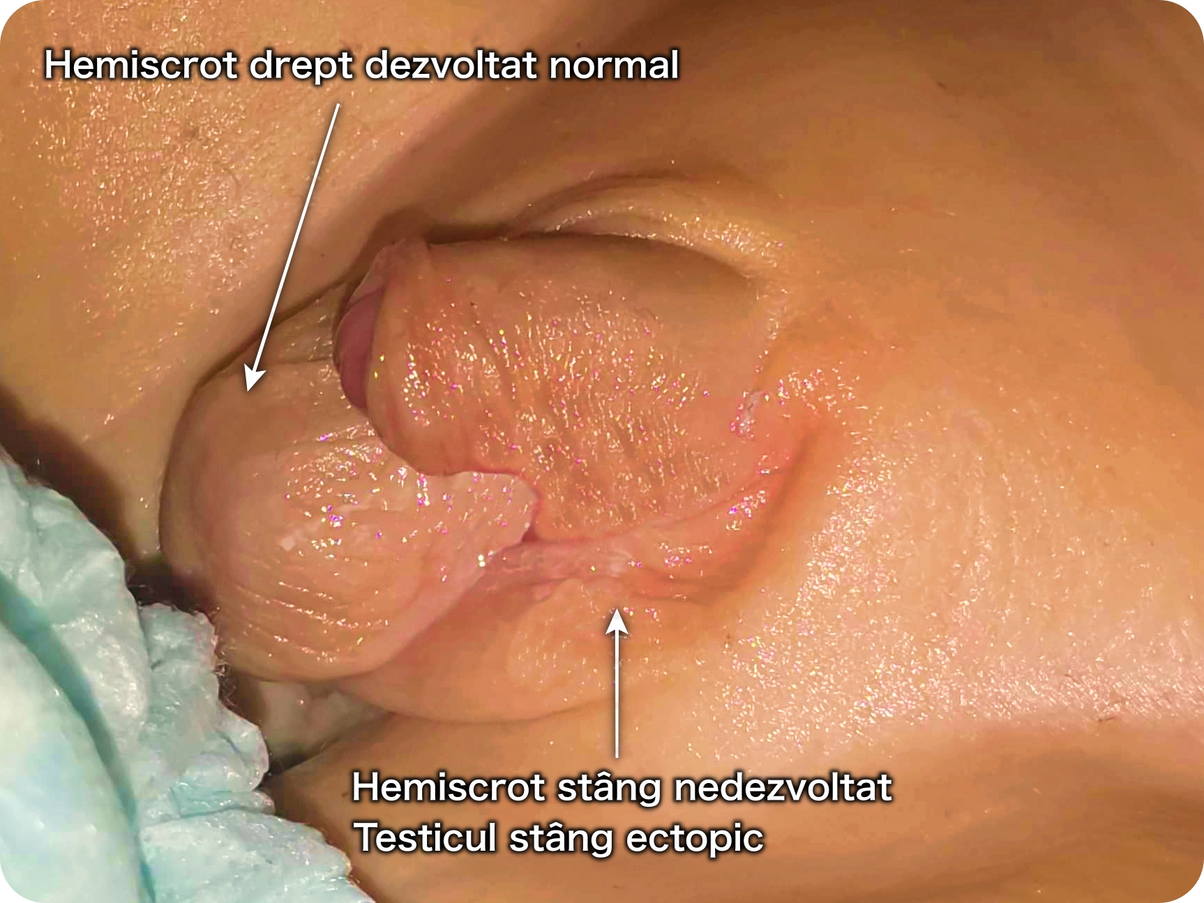 Agenezie de hemiscrot Agenezie de hemiscrot, hemiscrotum agenesia