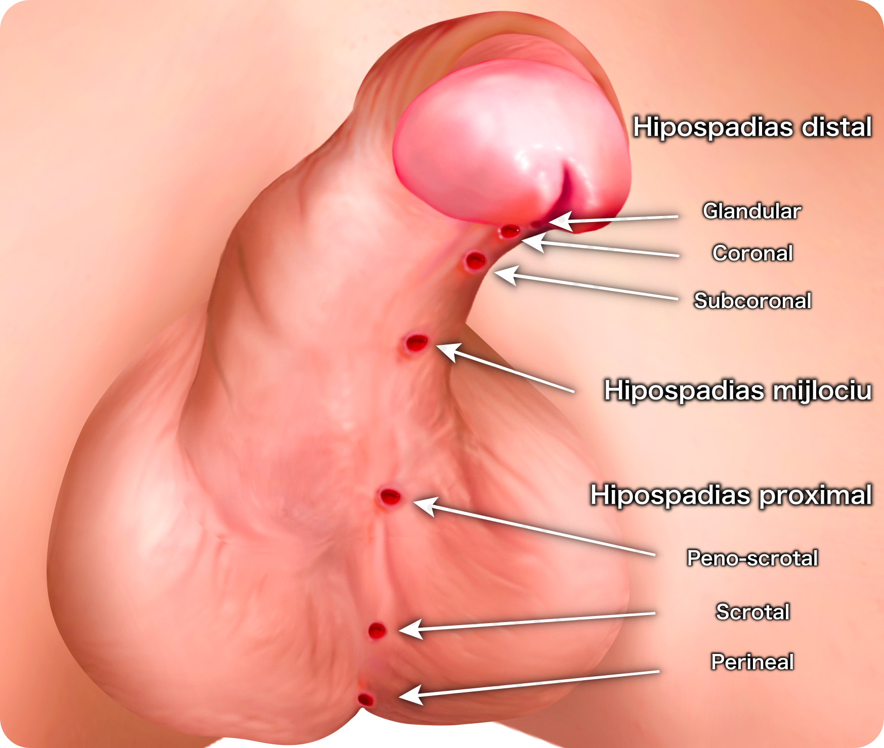 Hypospadias classification, clasificare hipospadias, hipospadias