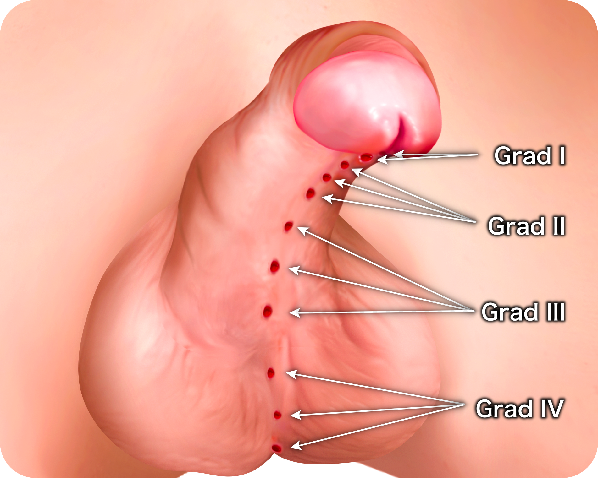 Hypospadias classification, clasificare hipospadias, hipospadias