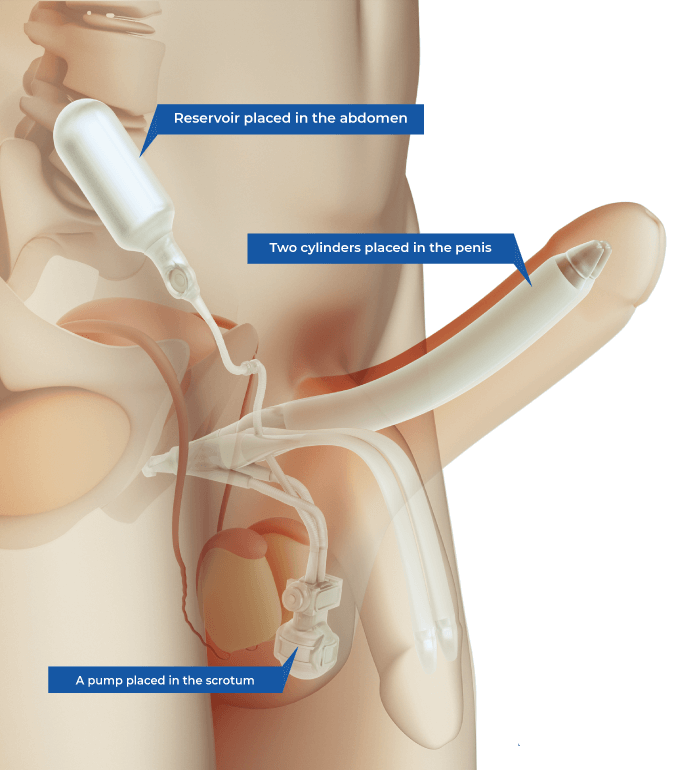 Inflatable penile prosthesis, Proteze peniene gonflabile, disfunctie erectila 