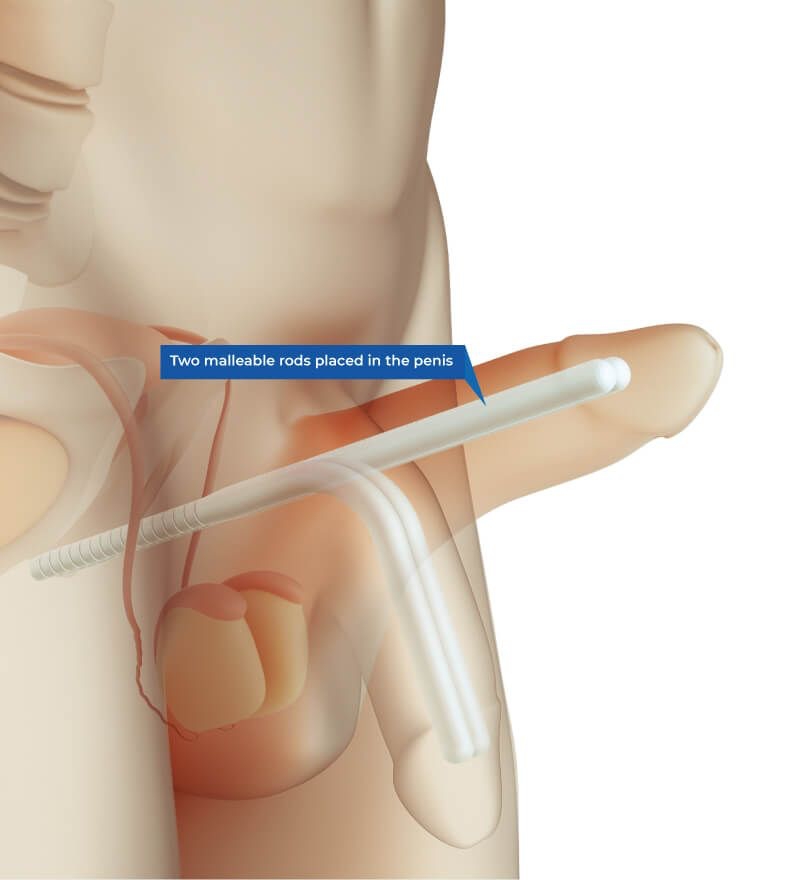 Malleable or semirigid penile prosthesis, proteze peniene maleabile sau semirigide