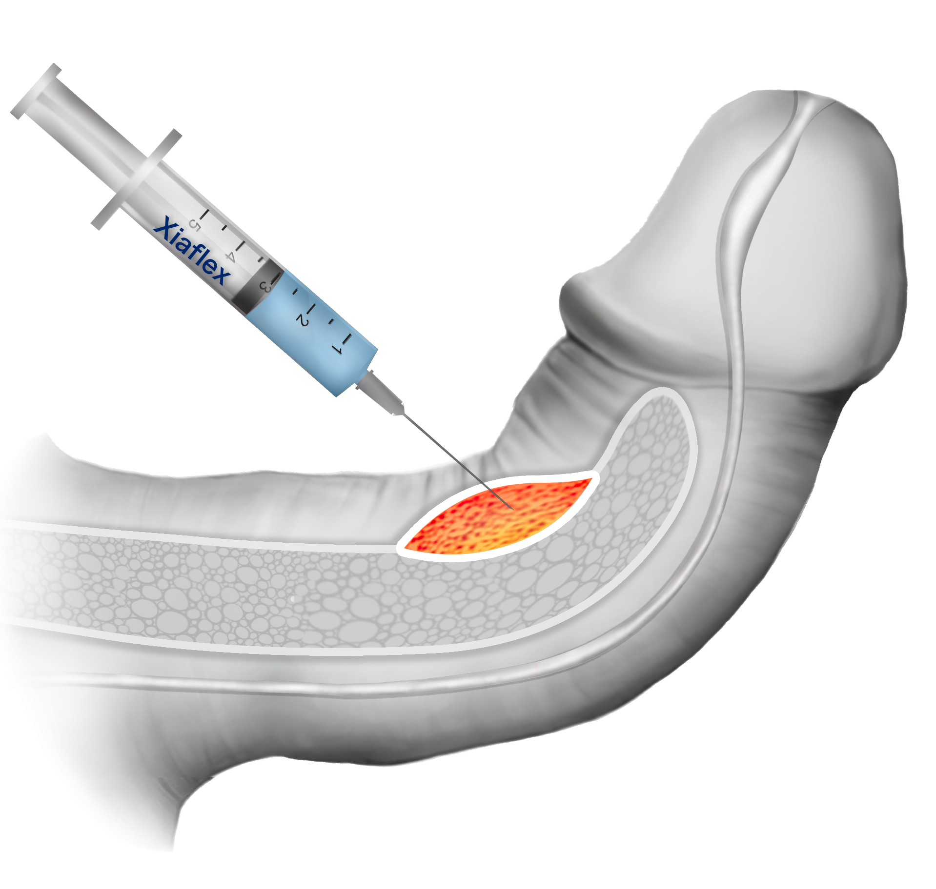 Xiaflex, Xiaplex, Clostridium Histolyticum collagenase for Peyronie