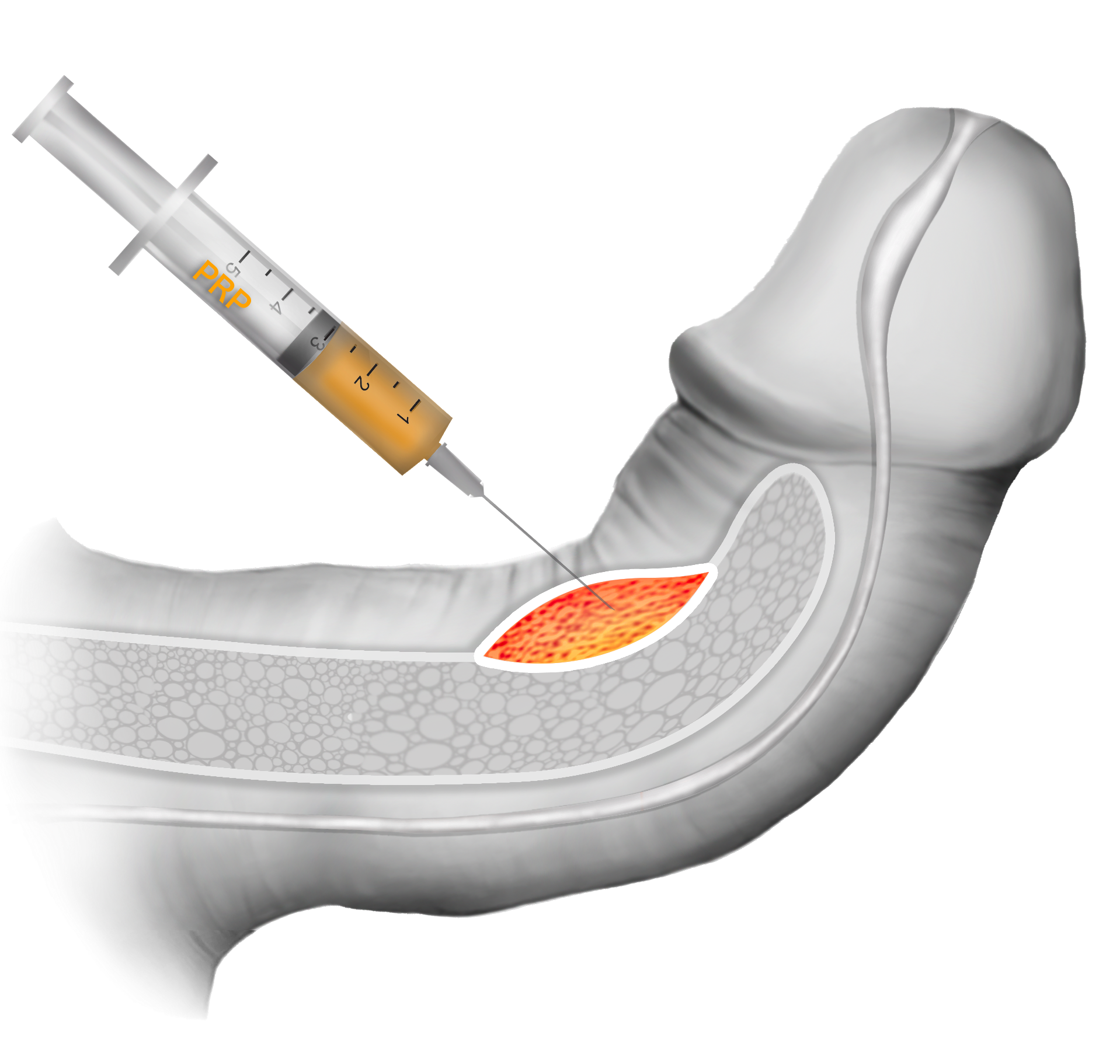 Platelet rich plasma, PRP, Peyronie